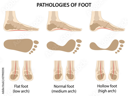 Pathologies of foot. Flat foot. Difference between sick and healthy feet. Vector illustration in flat style over white background photo