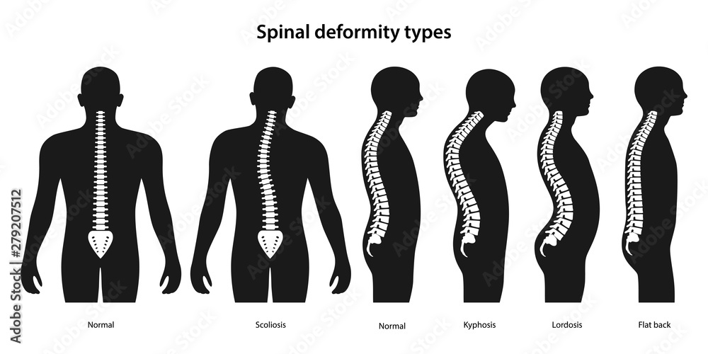 Spinal deformity types. White spine on a black body. Anterior view and lateral view of human body. Anatomical vector illustration in flat style isolated over white background. - obrazy, fototapety, plakaty 