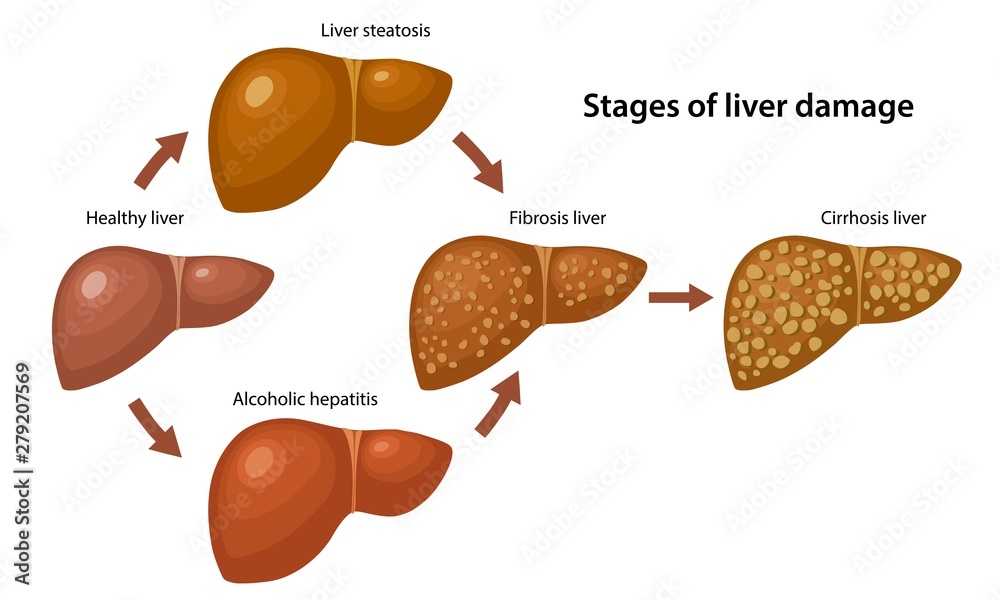 Stages of liver damage with description corresponding steps: healthy ...