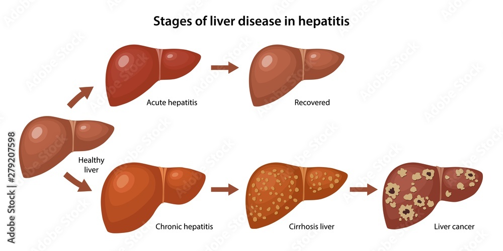 Stages of liver disease in hepatitis with description corresponding steps: healthy, acute, chronic hepatitis, cirrhosis and cancer liver. Vector illustration in flat style over white background - obrazy, fototapety, plakaty 