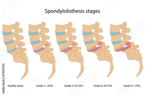 Spondylolisthesis stages with main description. Healthy spine and spine with spondylolisthesis in lateral view are isolated on white background. Vector illustration in flat style
