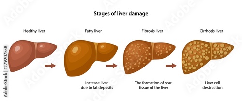 Stages of liver damage with description corresponding steps: healthy, fatty, fibrosis and cirrhosis liver. Anatomical vector illustration in flat style isolated over white background