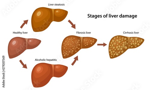 Stages of liver damage with description corresponding steps: healthy, fatty, fibrosis, alcoholic hepatitis and cirrhosis liver. Anatomical vector illustration in flat style over white background