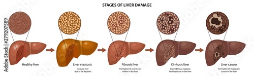 Stages of liver damage with description corresponding steps: healthy, fatty, fibrosis, cirrhosis and cancer liver. Vector illustration with histology in flat style isolated over white background photo