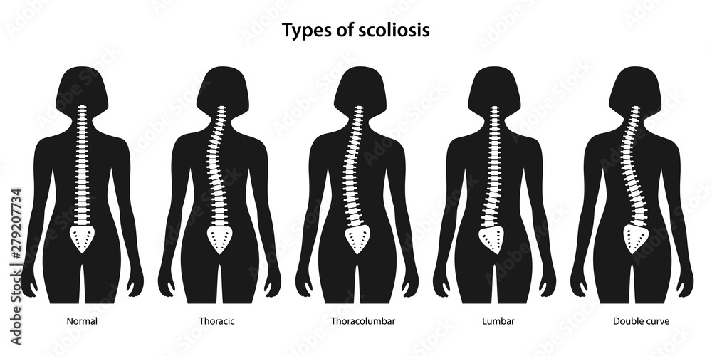 Types Of Scoliosis White Spine On A Black Women Body Anterior View 
