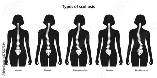Types of scoliosis. White spine on a black women body. Anterior view. Anatomical vector illustration in flat style isolated over white background.