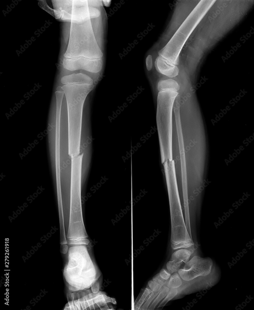 Radiography of Tibial fracture at mid shaft of the bone in young boy patient. Radiography of Tibial fracture at mid shaft of the bone in young boy patient.