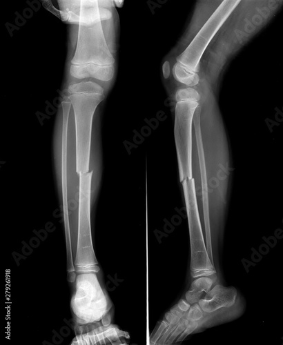 Fotografie, Obraz Radiography of Tibial fracture at mid shaft of the bone in young boy patient