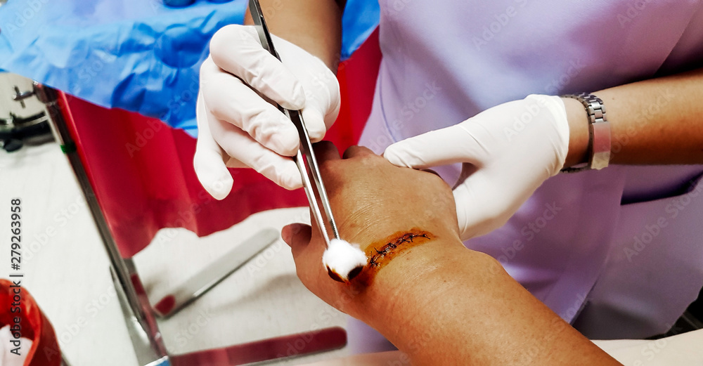 Close up of nurse's hand cleans and treats of hand injury after surgery