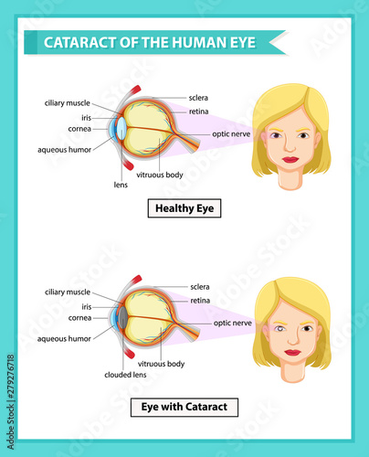 Scientific medical illustration of cataract of human eye