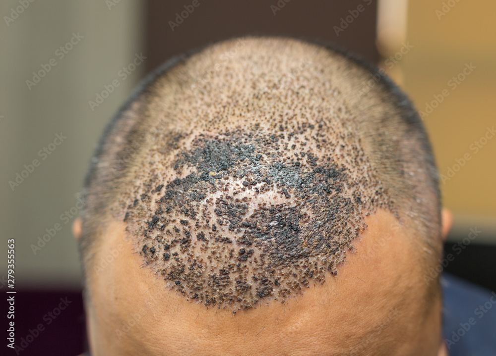 Top view of a man's head with hair transplant surgery. Bald head of hair  loss treatment Stock Photo | Adobe Stock