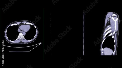 CT Chest with Contrast or CTA pulmonary artery axial NC  ,Coronal and sagittal view for diagnosis pulmonary embolism and lung disease.
