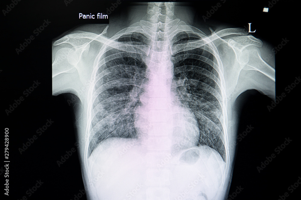 A chest xray film of a patient with viral or bacterial pneumonia. Stock