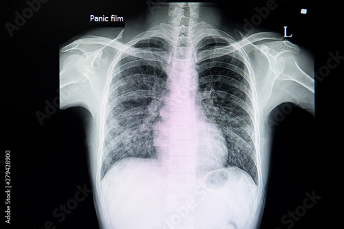 A chest xray film of a patient with viral or bacterial pneumonia.