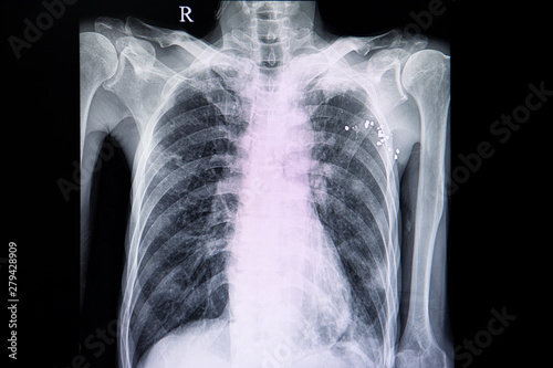 Fotografia chest xray of a patient with pulmonary emphysema
