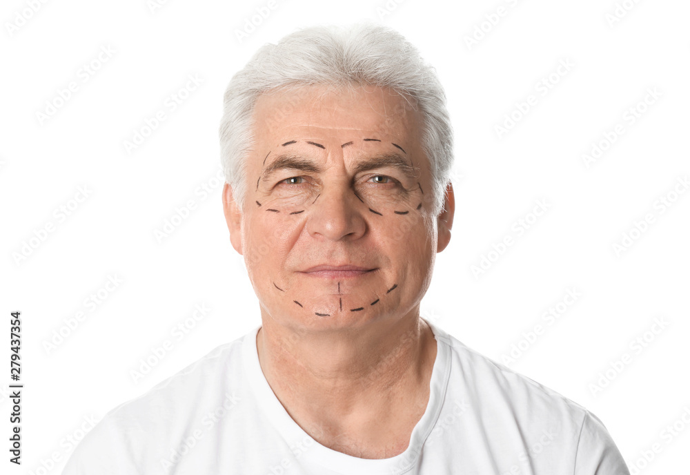 Mature man with marks on face for cosmetic surgery operation against white background Mature man with marks on face for cosmetic surgery operation against white background