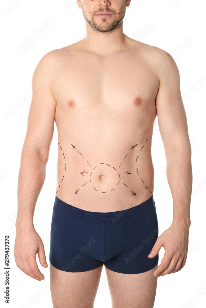 Man with marks on belly for cosmetic surgery operation against white background, closeup Man with marks on belly for cosmetic surgery operation against white background, closeup