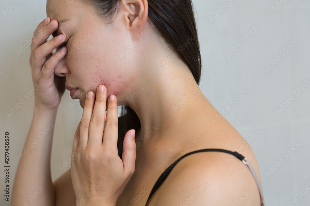 Fototapeta premium Woman stressed from face acne.