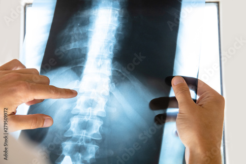 doctor examines x-ray picture of human spine