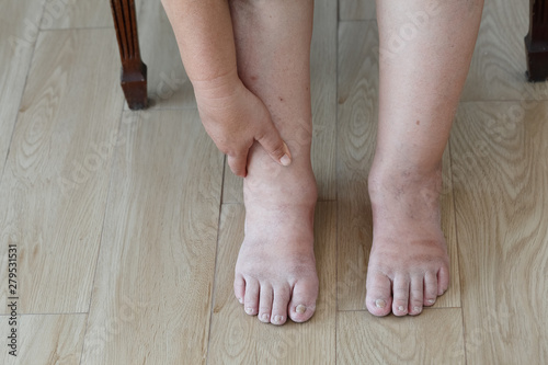 Fotografie, Obraz Senior woman swollen feet and leg