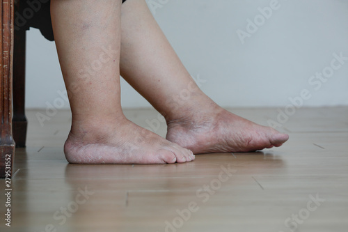 Obraz na plátně Senior woman swollen feet and leg