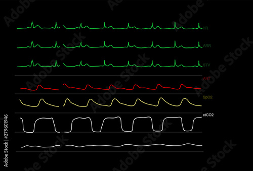 Monitoring display of patient vital signs