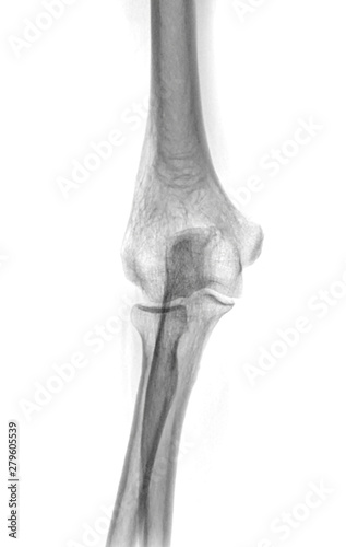 X-ray Elbow or Radiography of Right elbow AP view for diagnostic fracture of elbow. photo