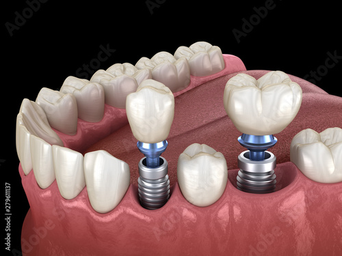 Premolar and Molar tooth crown installation over implant - concept. 3D illustration of human teeth and dentures