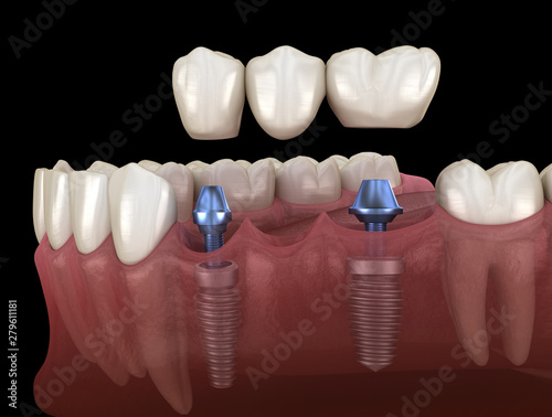 Εκτύπωση καμβά Dental bridge supported by implants