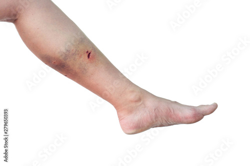 Caucasian woman's leg with a dog bite wound in the calf on isolated white background. Female leg with bite marks from a dog and a large bruise