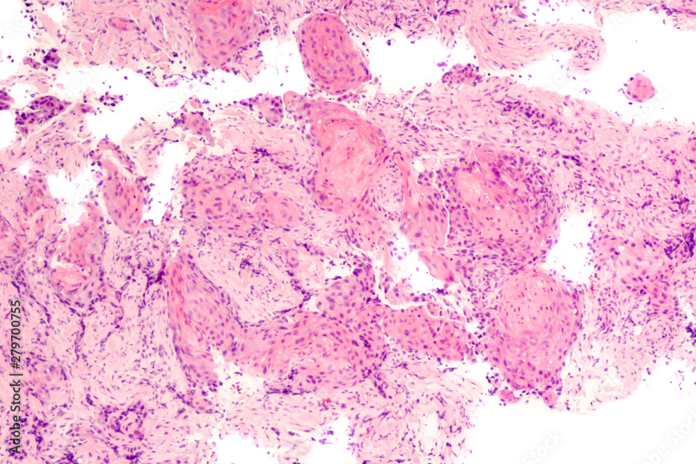 Foto Stock Lung Cancer Photomicrograph of a CT (CAT) scanguided