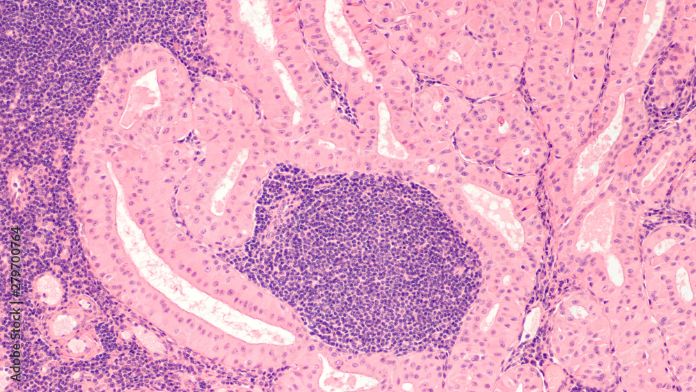 Microscopic image of a Warthin's tumor, a benign tumor of the salivary  gland. Stock Photo | Adobe Stock