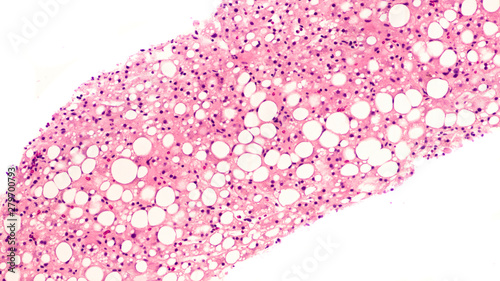 Photomicrograph of liver biopsy pathology histology (pathology) showing steatosis ("fatty liver"), which may be associated with diabetes mellitus, alcohol abuse, or toxins. 