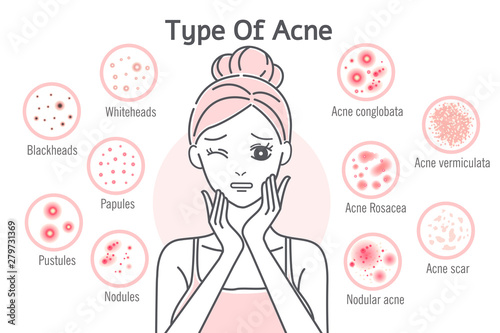 skin care type of acne photo