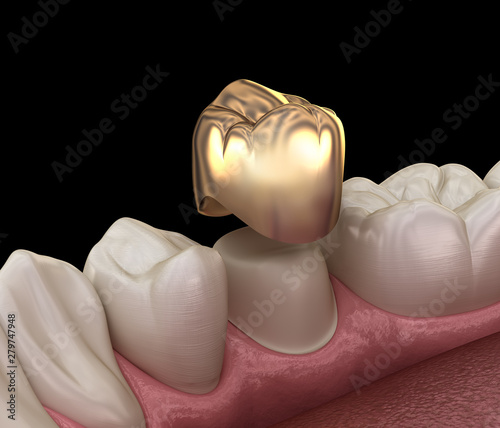 Fototapeta Naklejka Na Ścianę i Meble -  Golden crown premolar tooth assembly process. Medically accurate 3D illustration of human teeth treatment