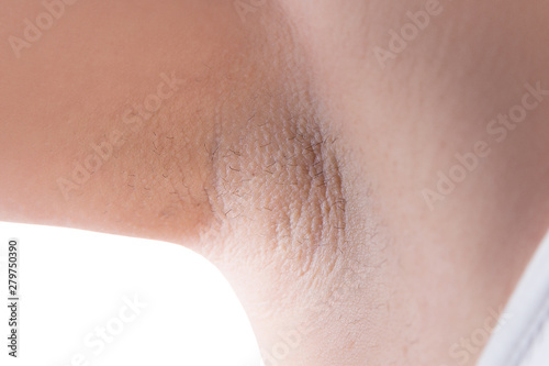 Armpit skin after laser hair removal