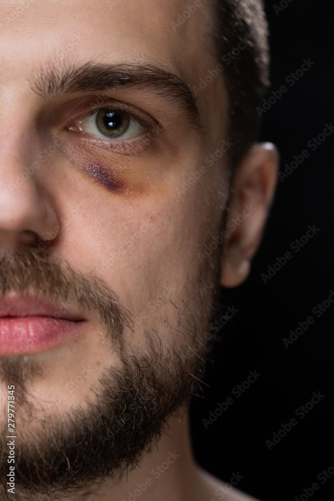 Man with shiner bruise black eye hematoma. Domestic violence male victim portrait concept. Man with shiner bruise black eye hematoma. Domestic violence male victim portrait concept.