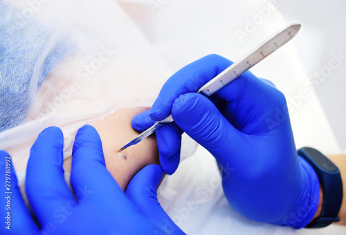 the surgeon beautician removes the patient's woman birthmark or birthmark on the hand with a radio wave knife. Electrosurgical high-frequency apparatus. Prevention of melanoma.