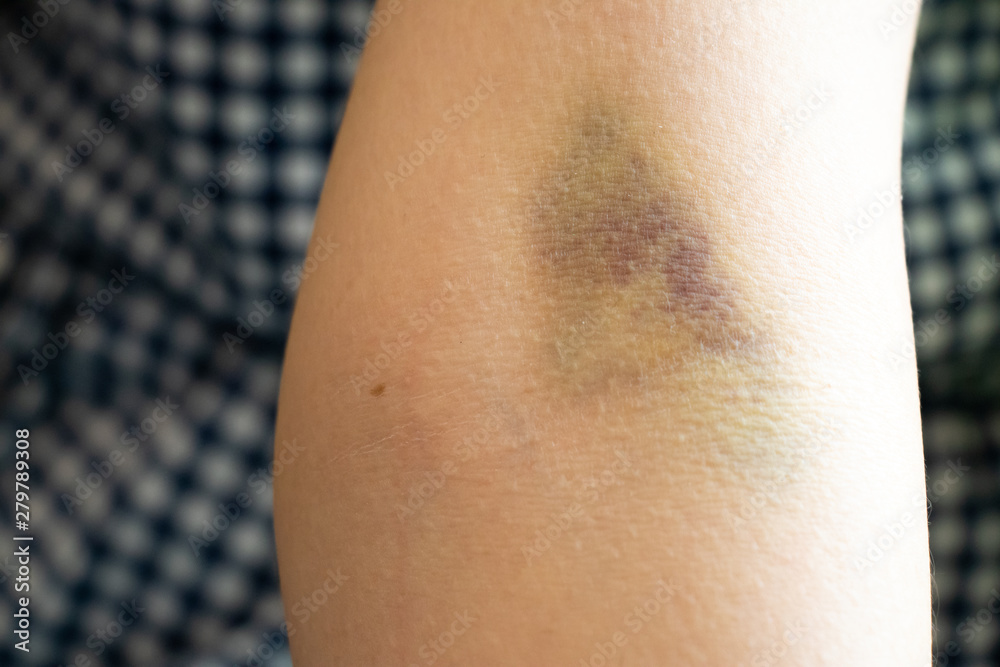 Bruise injury on the female arm background Bruise injury on the female arm background