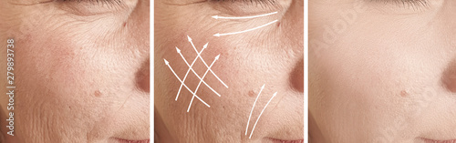 woman wrinkles face before and after treatment, arrow, photo