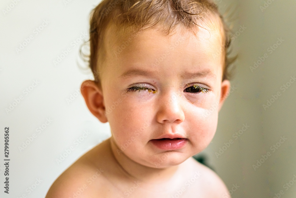 A baby with eyes full of rheum, produced by conjunctivitis