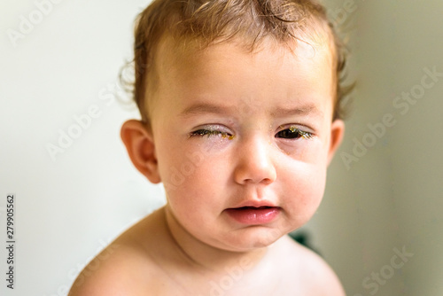 A baby with eyes full of rheum, produced by conjunctivitis, inflammation of the conjunctiva of bacterial origin. photo