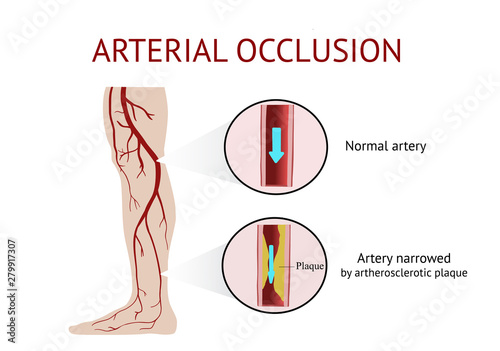 Arterial occlusion, Acute arterial occlusion, Atherosclerosis, Cramp, Vector Illustration 