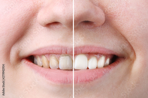 whitening or bleaching treatment ,before and after ,woman teeth and smile, close up, isolated on white