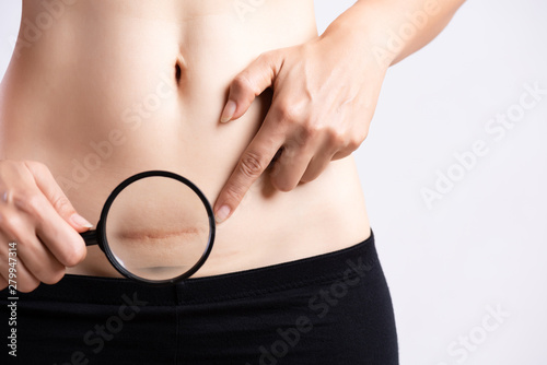 Closeup of woman showing on her belly dark scar from a cesarean section. Healthcare concept.