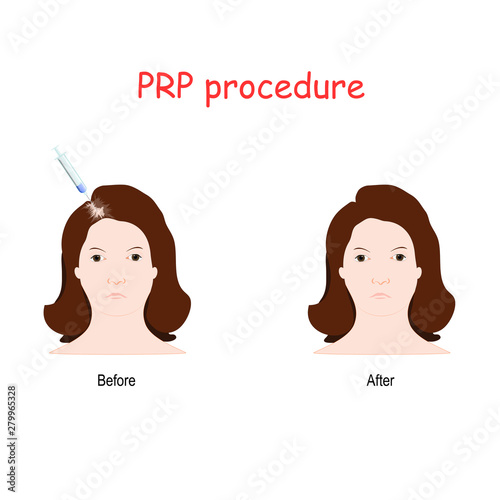 Platelet rich plasma (PRP) injection