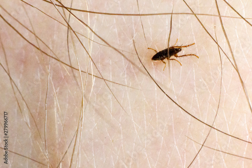 Fleas bite human skin. she is alive. A tiny parasite sucking the blood of people in a close shot. photo