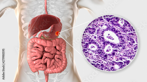 Foto Stomach adenocarcinoma, gastric cancer, 3D illustration and light micrograph