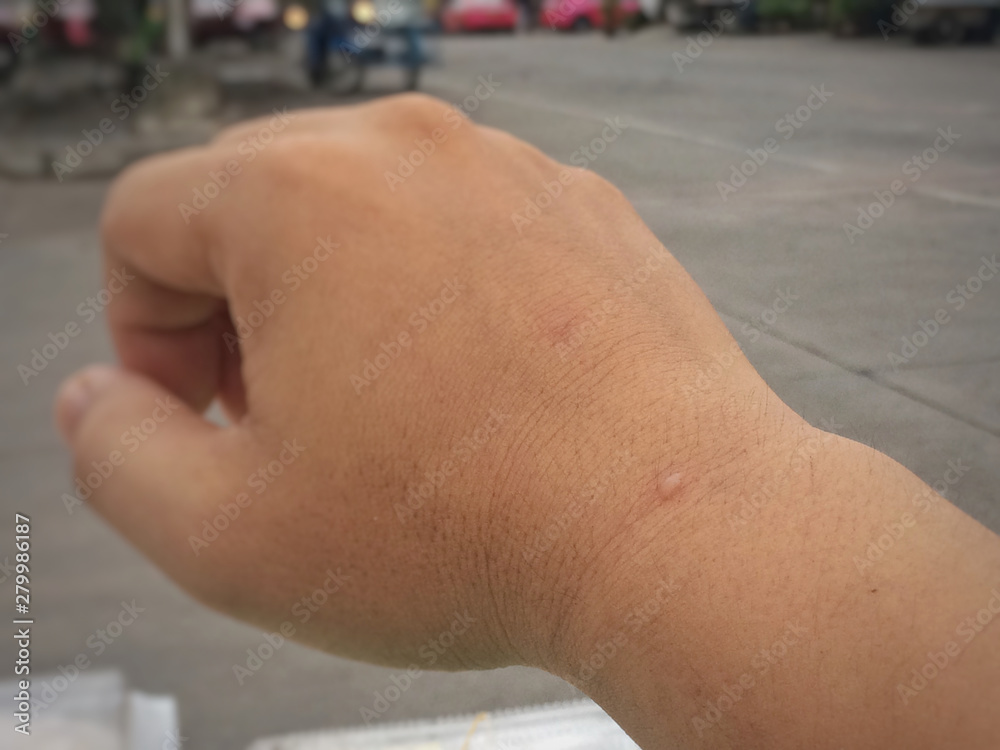 Fototapeta premium Blister on hand