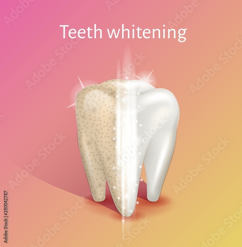 Tooth whitening in realistic 3d vector illustration.